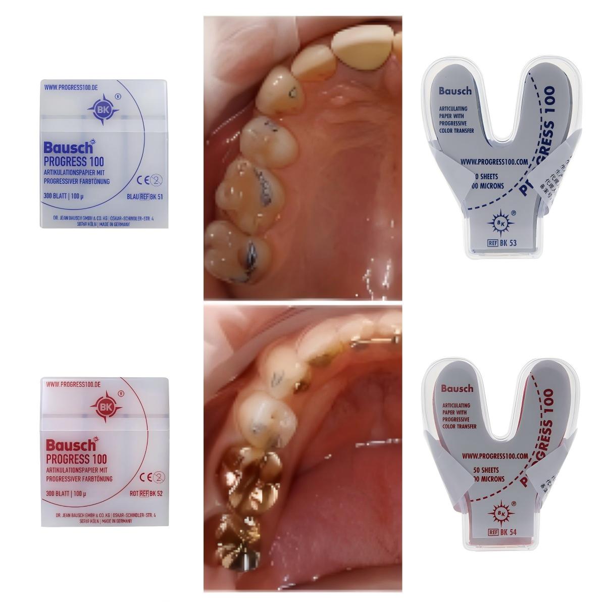 Bausch BK51 BK52 BK53 BK54 Den - Bite Indicator avis et prix